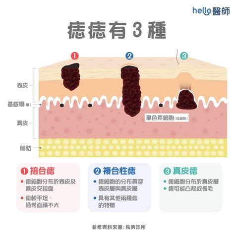 長毛的痣|痣形成的原因？痣長毛、痣變多變大是痣病變？5招判。